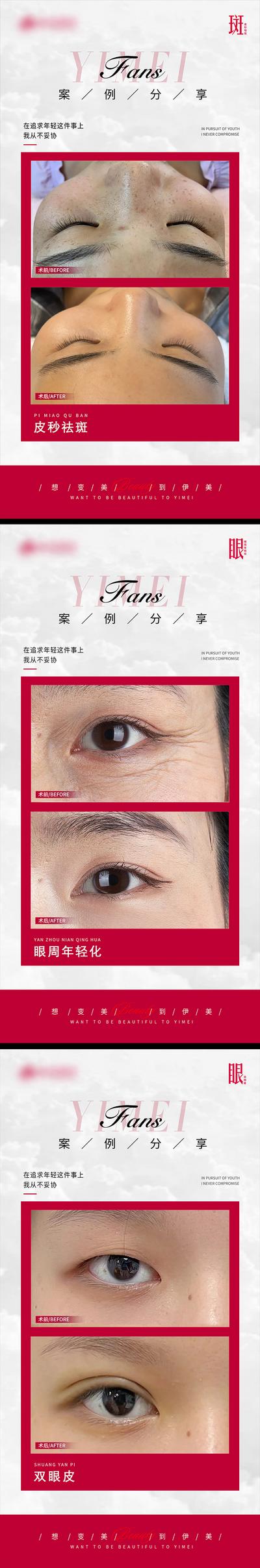 南门网 海报 医美 整形 皮秒祛斑 眼周年轻化 双眼皮 案例 对比