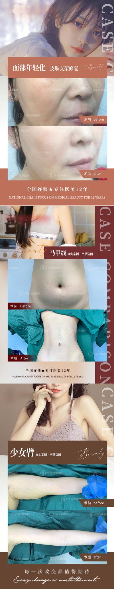 【南门网】海报 医美 案例 腰腹环吸 手臂 腰腹 对比 系列