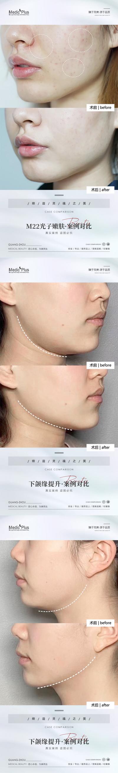 南门网 海报 医美 整形 美容 光子嫩肤 下颌缘提升 抗衰 案例 对比