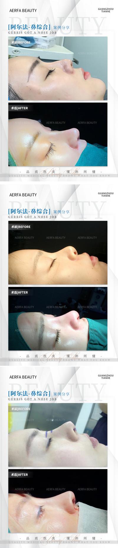 南门网 海报 医美 鼻子 鼻综合 案例 对比 系列