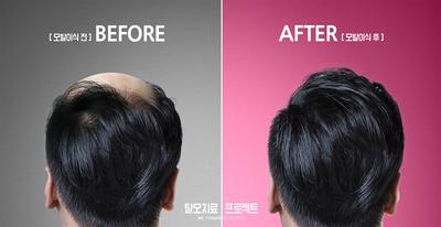 南门网 广告 海报 美业 植发 对比 案例 秃头 掉发 系列